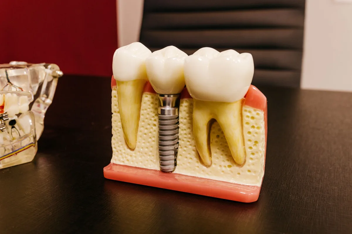 Un chirurgien-dentiste montre à un patient un modèle d'implant dentaire avec sa vis et sa couronne