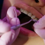 Un orthodontiste ajuste un appareil dentaire multibague sur une adolescente assise dans un fauteuil de cabinet dentaire
